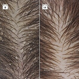 Kepek Karşıtı Nüks Önleyici Serum - Saç Serumu